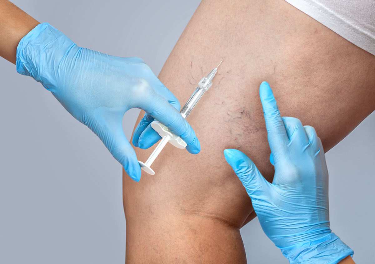 A doctor does medical procedure Sclerotherapy used to eliminate